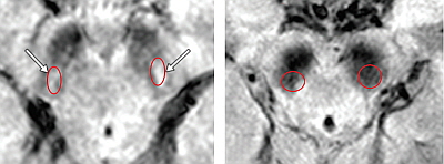 사진:렘수면행동장애환자 정상뇌(왼쪽)와 파킨슨병 발생 뇌MRI 영상