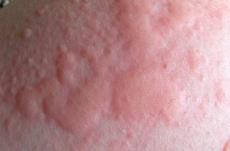 만성두드러기로 가려움증을 동반한 피부부종(팽진)과 주변의 붉은 기운(홍반)이 동시 발생한다