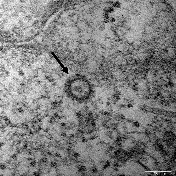 코로나19 바이러스(SARS-CoV-2)의 전자현미경 사진(질본 제공)