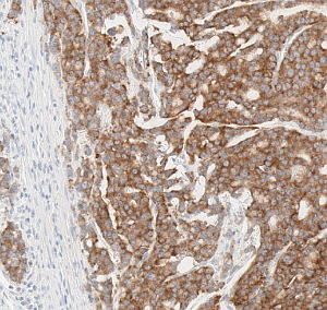 TRK변이가 있는 대장암 조직의 단백질 발현 염색이미지(한국로슈진단 제공)