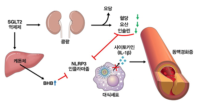 SGLT2 억제제는 콩팥을 통해 요당을 배출하도록 도와 혈액 내 포도당과 요산, 인슐린 수치를 낮춰 NLRP3 인플라마좀 활성을 억제한다. SGLT2 억제제는 간에서 케톤체를 생성해 혈액 내 β-하이드록시부티르산(BHB)을 증가시켜 NLRP3 인플라마좀을 억제하는 것으로 이번 연구에서 밝혀졌다. 억제된 NLRP3은 대식세포내 사이토카인의 생산을 줄이는 것으로 확인됐다. 사이토카인은 죽상동맥경화증을 유발한다(세브란스 제공).