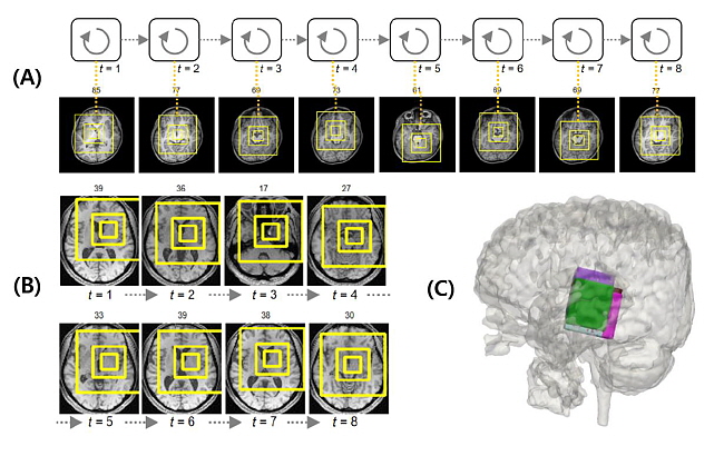A. 세브란스병원 ASD 환자의 MRI 빅데이터에서 인공지능 모델이 자폐 중증도와 관련된 뇌 주요 부위들의 연관 관계를 찾아내는 모습B. 국제컨소시엄으로 구축된 1000여 건의 자폐증 환자 MRI 빅데이터에서 인공지능 모델이 자폐 중증도와 관련된 뇌 주요 부위들의 연관 관계를 찾아내는 모습C. A와 B의 주요 부위를 3차원으로 표현한 뇌 이미지