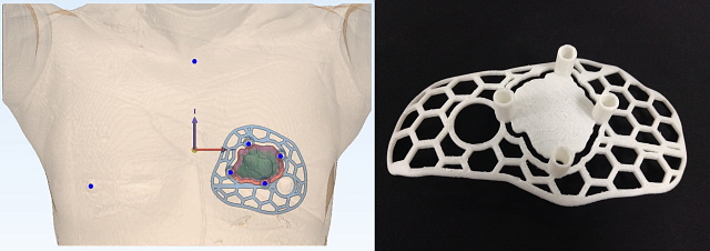 환자 맞춤형 3D 수술 가이드 적용 그래픽(왼쪽)과 실제사진