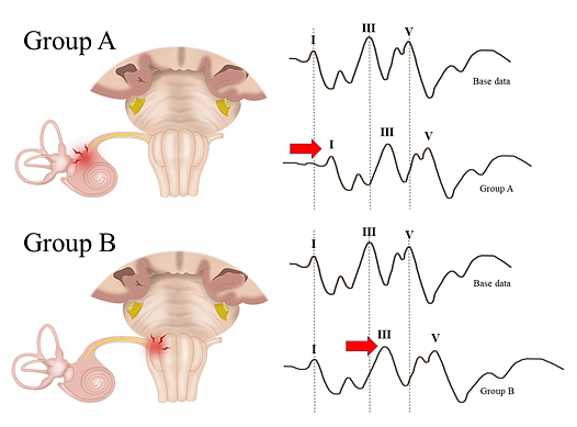 청신경이 영향을 받은 파형(A군)과 뇌간에 영향을 받은(그룹B) 파형.