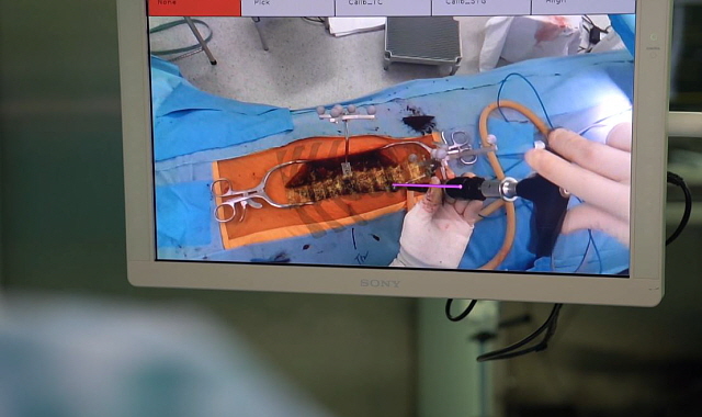 오버레이 그래픽으로 척추경나사를 삽입하는 모습(분당서울대병원 제공)