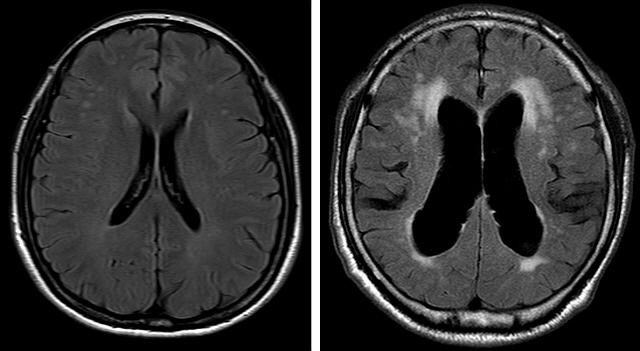 정상 뇌(왼쪽)과 정상압 수두증의 MRI 영상(분당서울대병원 제공)