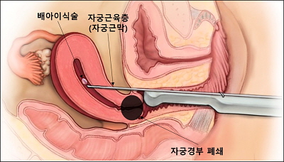 자궁근막 통과 배아이식술(분당서울대병원)