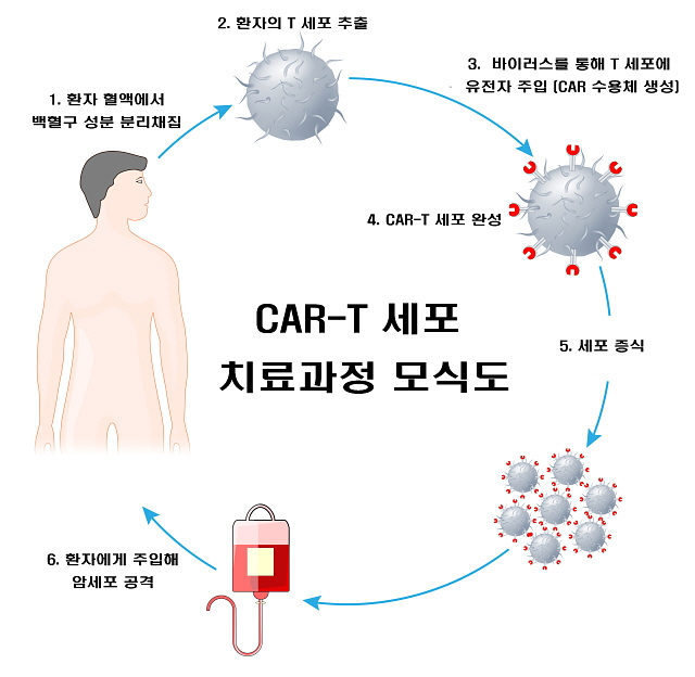 그림1. CAR-T 세포 치료과정 모식도(서울대병원 제공)