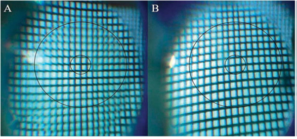 다초점 인공수정체(A)와 일반(단초점) 인공수정체(B)의 현미경 시야 비교 : (A) 작은 원내는 선명하지만 주변부(큰 원)는 흐리다. (B)은 모두 선명하게 보인다[분당서울대병원 제공]