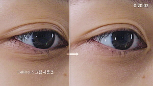 셀리놀-5 크림 사용 후 단시간 사용 후 눈가주름 개선 효과[사진제공 셀템제약]