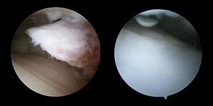 29세 남성의 발목관절염 줄기세포 치료 전(왼쪽)과 후[연세사랑병원 제공]