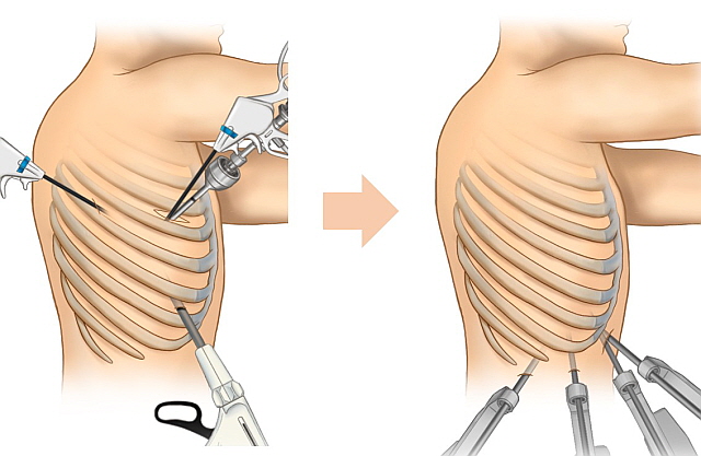흉강경 폐 수술과(왼쪽) 늑간 보존 로봇 폐절제술[분당서울대병원 제공]