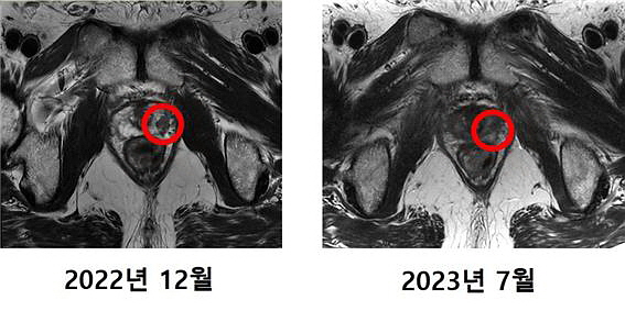첫 중입자치료환자의 MRI 비교 사진[세브란스병원 제공]