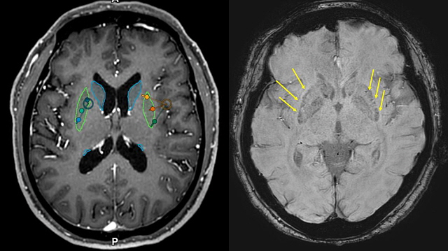 이식 전(왼쪽)과 후(오른쪽) MRI, 이식 후 MRI에서 성공적으로 세포가 이식된 부위를 확인할 수 있다(화살표)[사진제공 세브란스병원]