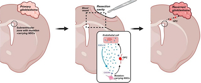 교모세포종 재발 매커니즘 모식도: 초발 교모세포종(왼쪽)에서는 암 유발 원인인 돌연변이 유전자를 가진 신경줄기세포가 뇌 깊은 곳에서 위치한다. 초발 종양을 수술로 제거해도(중앙) 혈관내피세포가 분비하는 신호가 신경줄기세포를 자극해 재발 부위로 이동을 촉진한다. 재발 교모세포종(오른쪽)에서는 이동한 신경줄기세포가 재발암을 형성한다[그림제공 서울대병원]
